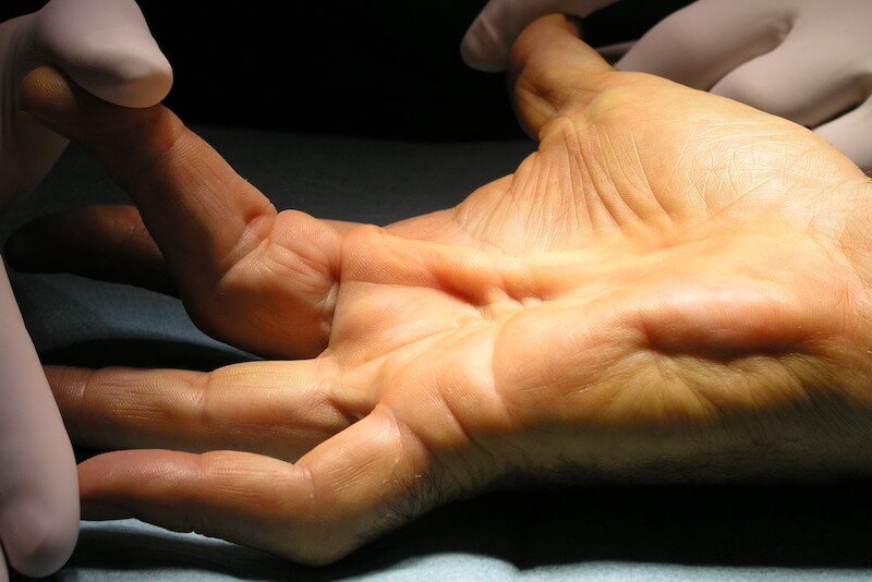 syndrome canal carpien diagnostic - maladie de dupuytrens canal carpien - canal carpien doigt bloqué - nodule dans la paume de la main