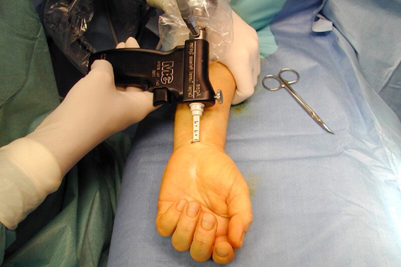 Intervention chirurgicale canal carpien par endoscopie