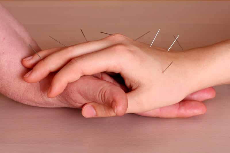 point acupuncture canal carpien - canal carpien traitement acupuncture - traitement canal carpien sans chirurgie